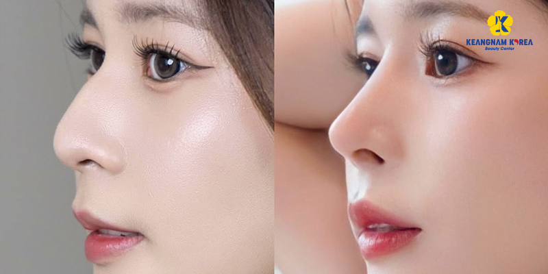 Nâng mũi bao nhiêu ngày thì cắt chỉ? 2 nâng mũi bao nhiêu ngày thì cắt chỉ