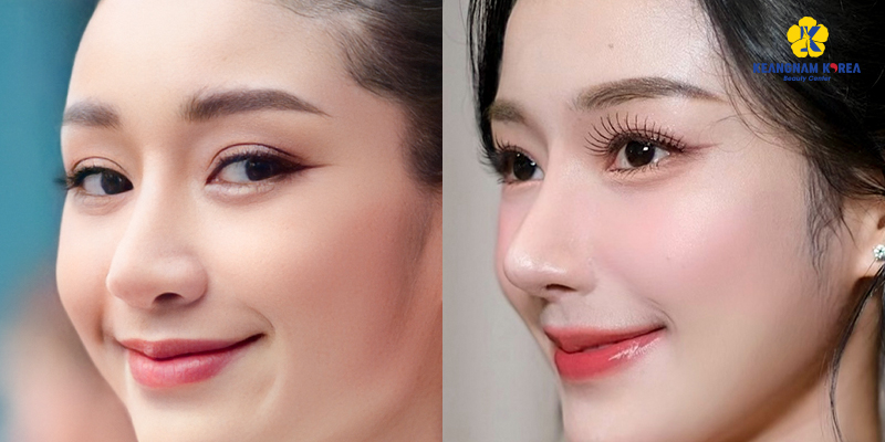 Nâng mũi bao nhiêu ngày thì cắt chỉ? 3 nâng mũi bao nhiêu ngày thì cắt chỉ