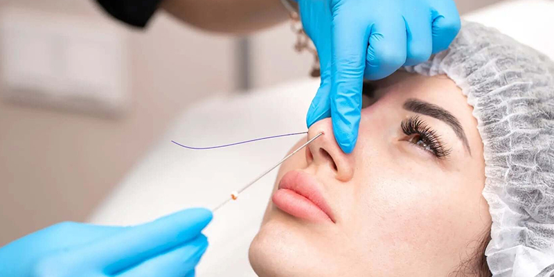 Nâng mũi bao nhiêu ngày thì cắt chỉ? 1 nâng mũi bao nhiêu ngày thì cắt chỉ