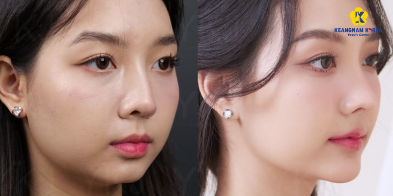 Nâng mũi bọc sụn có vĩnh viễn không? Được bao nhiêu năm? 4 nâng mũi bọc sụn có vĩnh viễn không