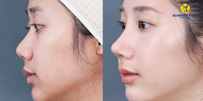 Nâng mũi bọc sụn có vĩnh viễn không? Được bao nhiêu năm? 5 nâng mũi bọc sụn có vĩnh viễn không