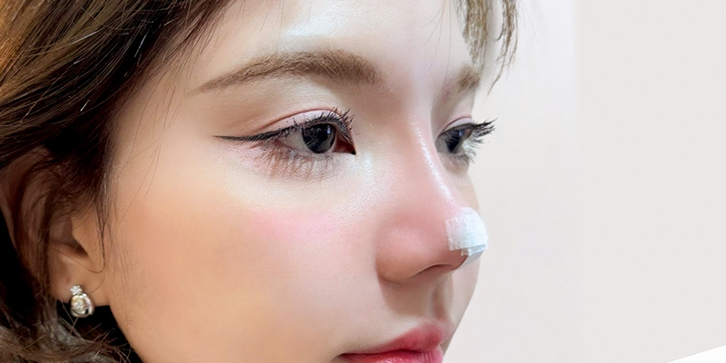 Nâng mũi chỉ Hiko giá bao nhiêu? Có tốt không? 1 nâng mũi chỉ hiko giá bao nhiêu