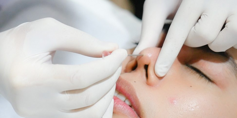 Nâng mũi chỉ Hiko giá bao nhiêu? Có tốt không? 3 nâng mũi chỉ hiko giá bao nhiêu