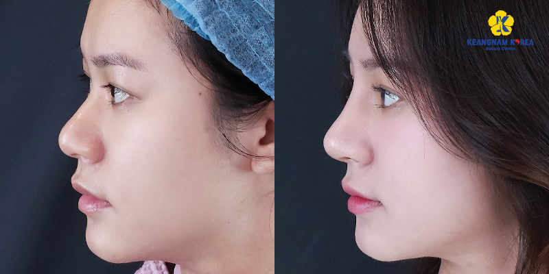 Nâng mũi chỉ sinh học là gì? Có tốt không? 3 nâng mũi chỉ sinh học là gì