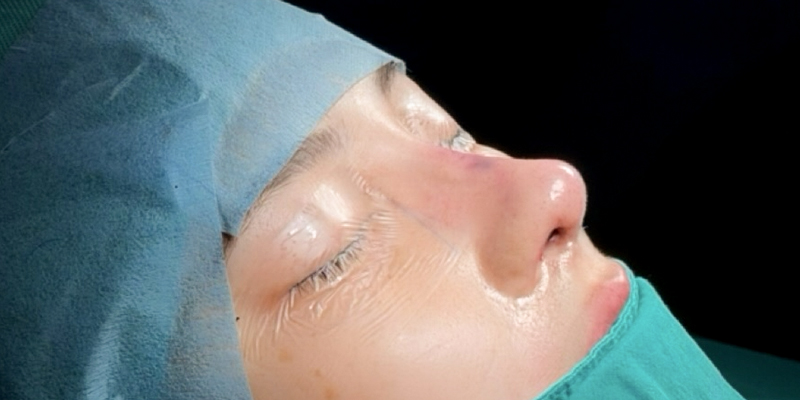 Nâng mũi chỉ sinh học là gì? Có tốt không? 4 nâng mũi chỉ sinh học là gì