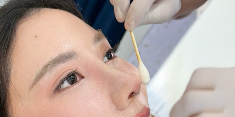 Nâng mũi chỉ sinh học là gì? Có tốt không? 5 nâng mũi chỉ sinh học là gì