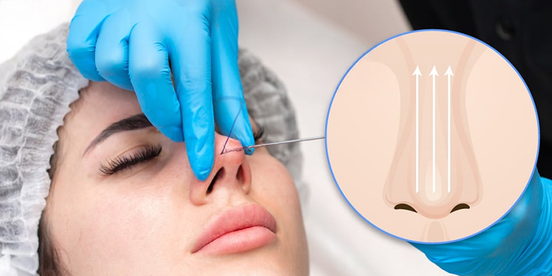 Nâng mũi chỉ sinh học là gì? Có tốt không? 1 nâng mũi chỉ sinh học là gì