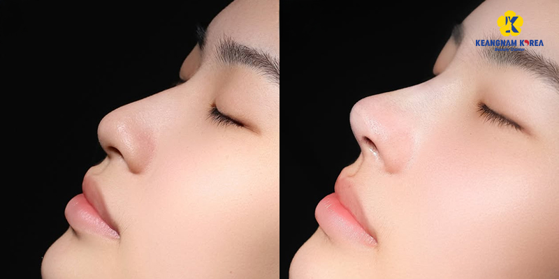 Nâng mũi bằng phương pháp nào an toàn nhất? 6 Nâng mũi S-line