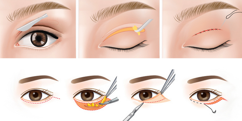 Phẫu thuật nâng cơ mí mắt là gì? 2 nâng cơ mí mắt là gì