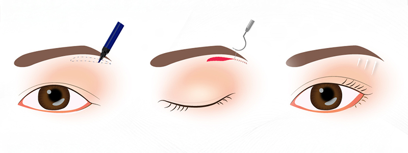 Phẫu thuật nâng cơ mí mắt là gì? 3 nâng cơ đuôi mắt