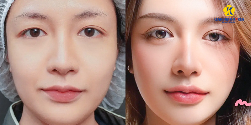 Phẫu thuật sụp mí mắt giá bao nhiêu 2 phẫu thuật sụp mí mắt giá bao nhiêu