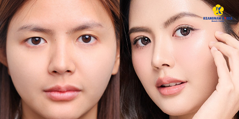 Phẫu thuật sụp mí mắt giá bao nhiêu 3 phẫu thuật sụp mí mắt giá bao nhiêu