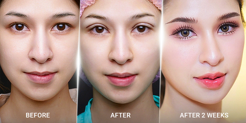 Phẫu thuật sụp mí mắt giá bao nhiêu 4 phẫu thuật sụp mí mắt giá bao nhiêu