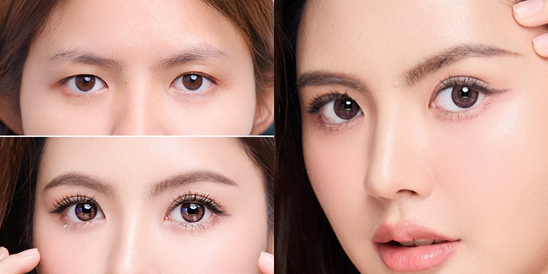 Phẫu thuật sụp mí mắt giá bao nhiêu 1 phẫu thuật sụp mí mắt giá bao nhiêu