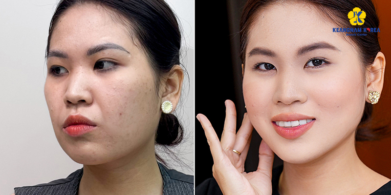 Quy trình căng da mặt gồm những gì: thời gian, hiệu quả & mức độ an toàn 5 quy trình căng da mặt