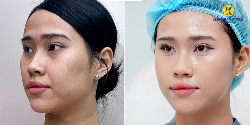 Quy trình căng da mặt gồm những gì: thời gian, hiệu quả & mức độ an toàn 6 quy trình căng da mặt