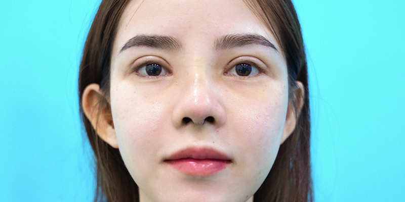 Review Cắt Mí Mắt Ở Đâu Đẹp Tại Hồ Chí Minh? Top Địa Chỉ Uy Tín Được Đánh Giá Cao 3 Hình ảnh cắt mí tại Keangnam Korea sau 7 ngày