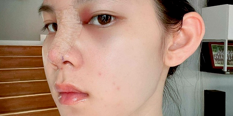 Gợi ý thực đơn cho người mới nâng mũi và những đại kỵ cần tránh 2 thực đơn cho người mới nâng mũi