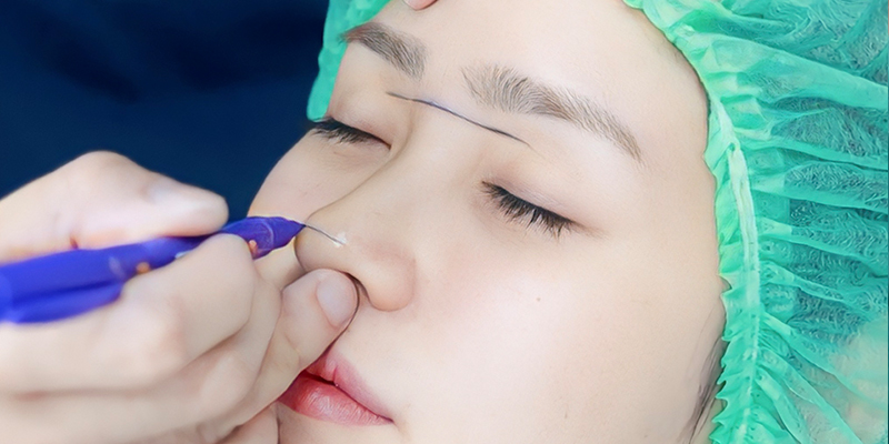 Tiêm tan filler bao lâu thì nâng mũi được? 3 Tiêm filler xong có nâng mũi được không?