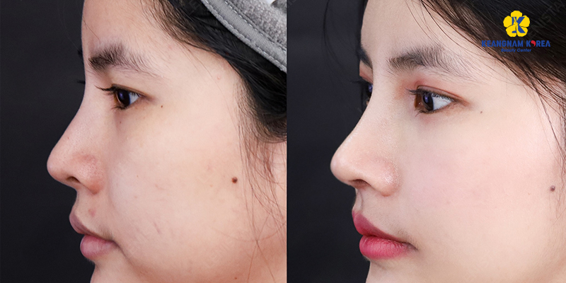 Tiêm tan filler bao lâu thì nâng mũi được? 4 tiêm tan filler bao lâu thì nâng mũi được