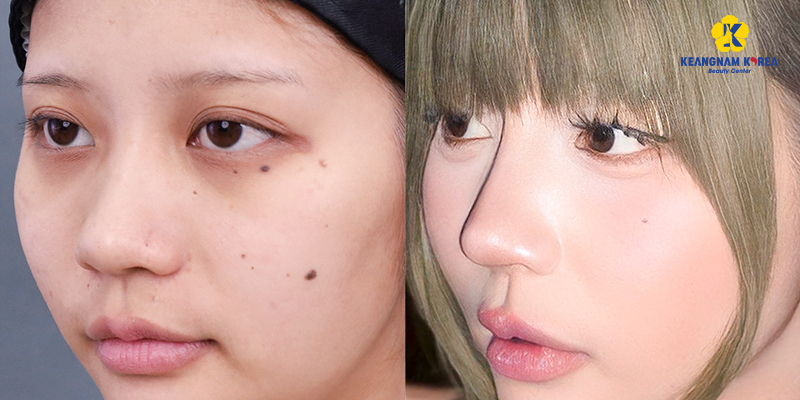 Tiêm tan filler bao lâu thì nâng mũi được? 5 tiêm tan filler bao lâu thì nâng mũi được