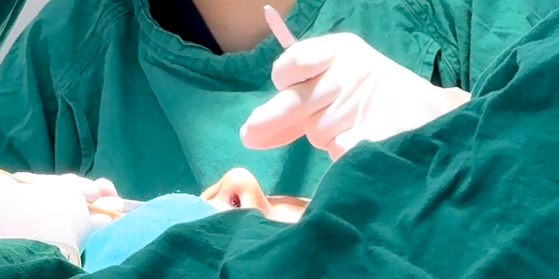 Tiêm tan filler bao lâu thì nâng mũi được? 6 tiêm tan filler bao lâu thì nâng mũi được