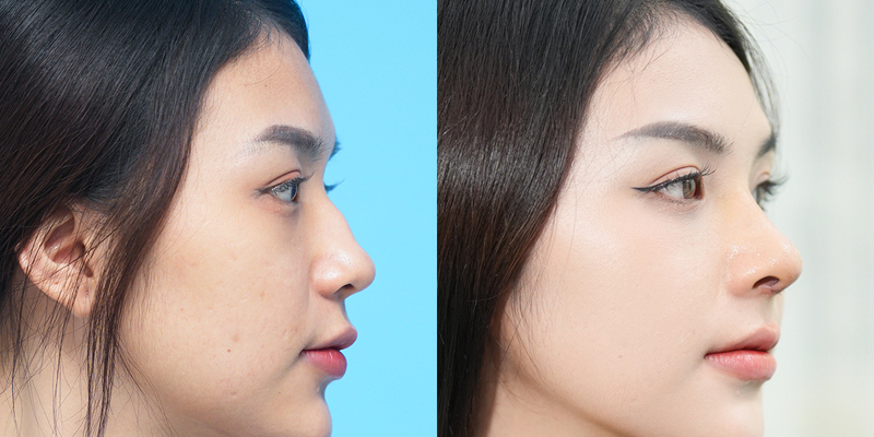 Vietnam vs Korea Plastic Surgery: 2026 Cost & Quality Comparison 3 Vietnam vs Korea Plastic Surgery