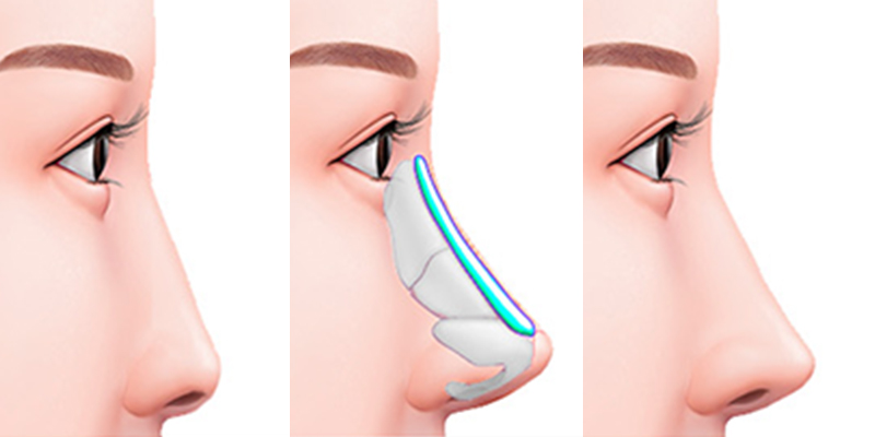 5 Types of Nose Jobs in Vietnam & 2026 Costs 1 5 Types of Nose Jobs in Vietnam & 2026 Costs
