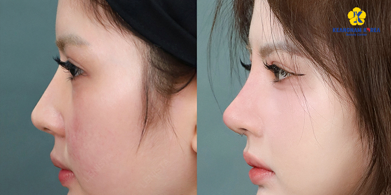 8 cách làm mũi cao tự nhiên mà vẫn an toàn theo chuẩn công nghệ mới nhất hiện nay 4 8 cách làm mũi cao tự nhiên