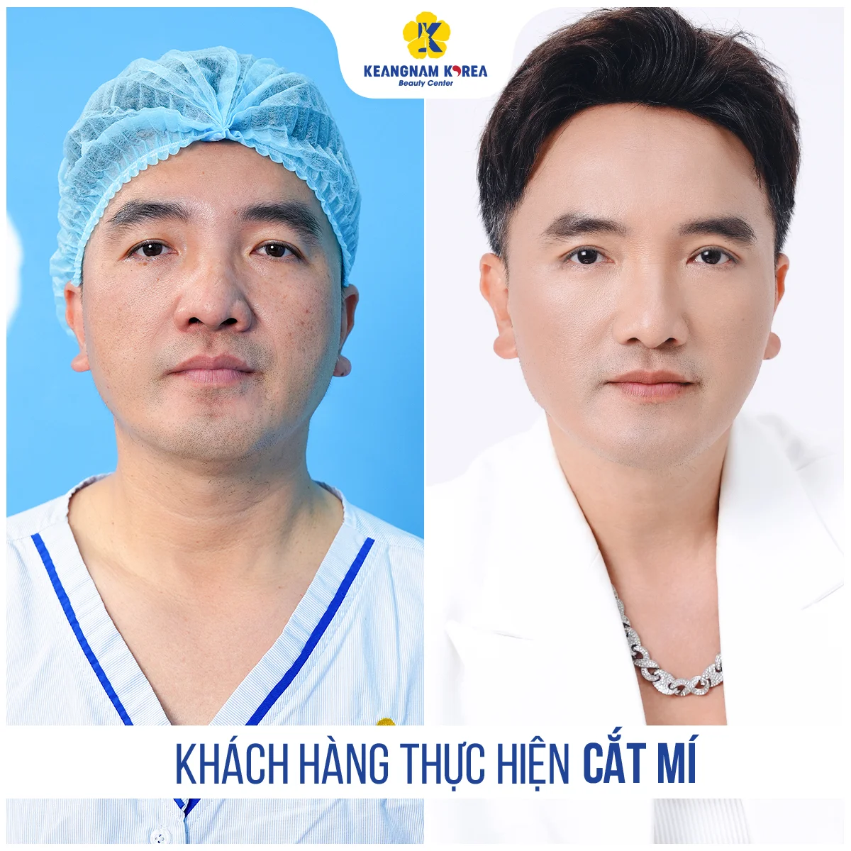 BF AF CM KOL2