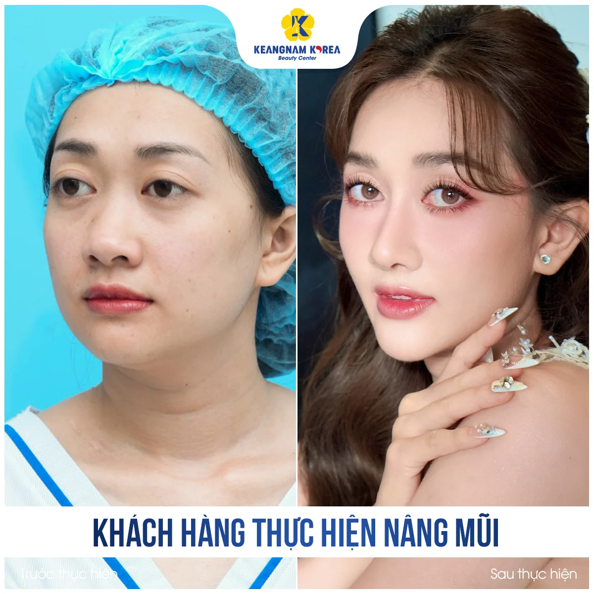 BF AF NANG MUI Phuong Lan