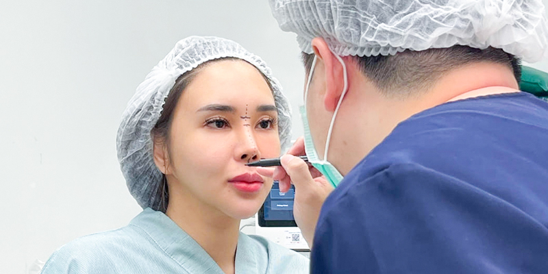 Nâng mũi gồm những phương pháp nào? Giá bao nhiêu? Bao lâu thì đẹp? Có nguy hiểm không? Các kinh nghiệm và rủi ro thường gặp 3 nâng mũi cấu trúc