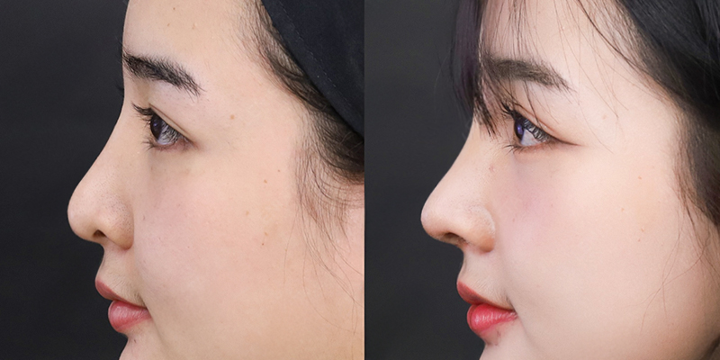 8 cách làm mũi cao tự nhiên mà vẫn an toàn theo chuẩn công nghệ mới nhất hiện nay 8 8 cách làm mũi cao tự nhiên