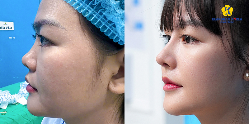 Nâng mũi gồm những phương pháp nào? Giá bao nhiêu? Bao lâu thì đẹp? Có nguy hiểm không? Các kinh nghiệm và rủi ro thường gặp 8 Hình ảnh thực tế trước và sau nâng mũi tại Keangnam Korea