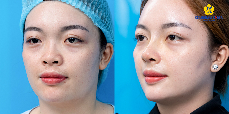 Nâng mũi gồm những phương pháp nào? Giá bao nhiêu? Bao lâu thì đẹp? Có nguy hiểm không? Các kinh nghiệm và rủi ro thường gặp 7 Hình ảnh thực tế trước và sau nâng mũi tại Keangnam Korea