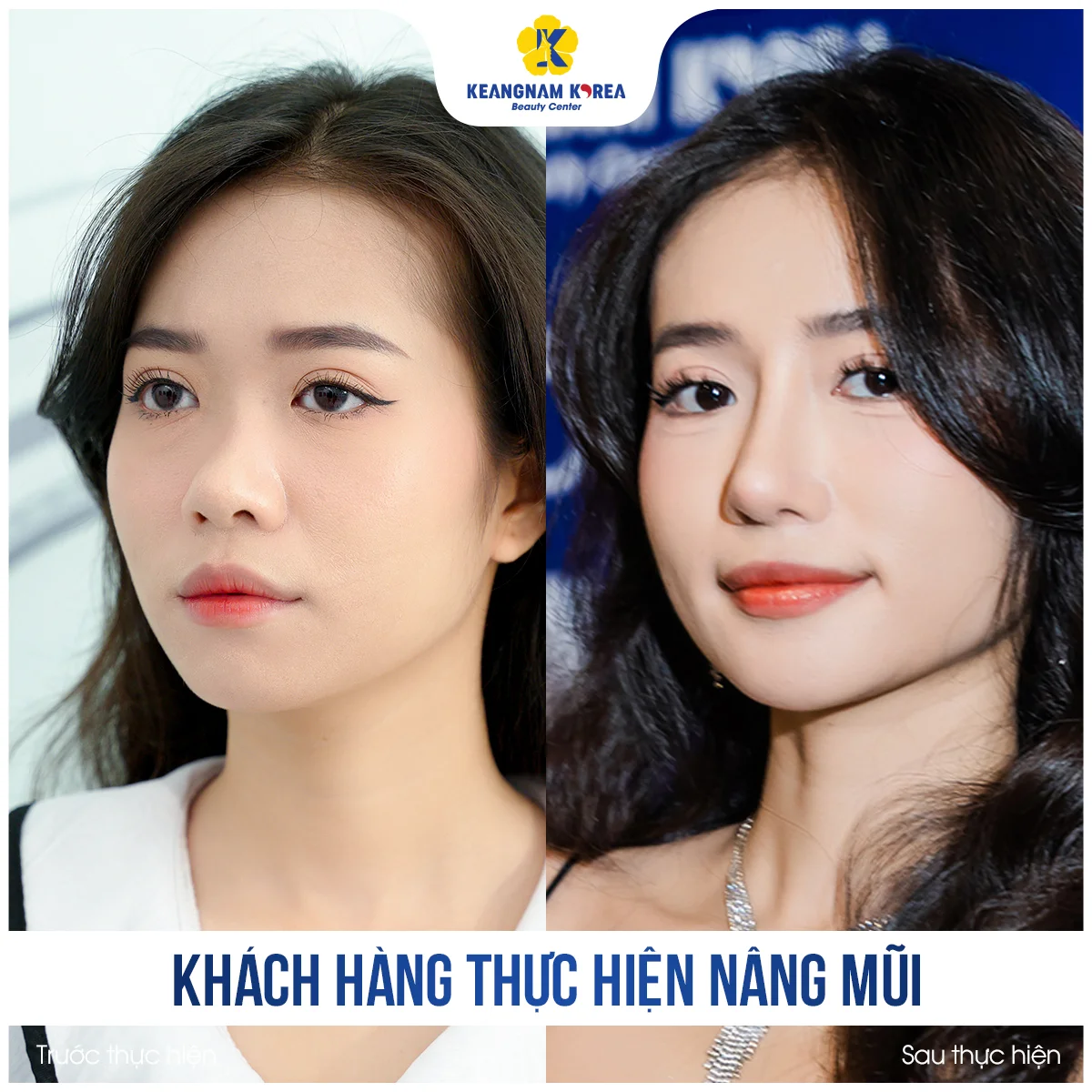 Nâng mũi TikToker Thủy Rolly tại Keangnam Korea