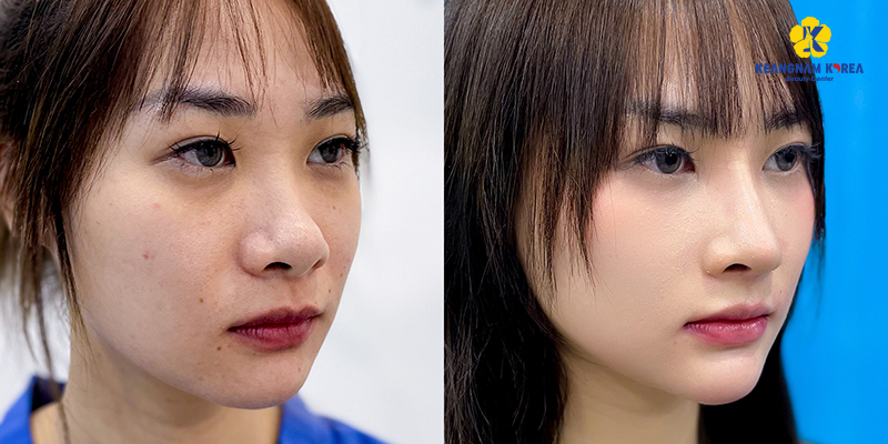 Sống mũi cao, thẳng có ý nghĩa gì trong thẩm mỹ? Đâu là các phương pháp nâng mũi phù hợp để có sống mũi cao? 5 nâng sống mũi cao thẳng ở đâu