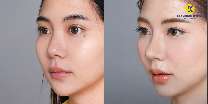 Nâng mũi gồm những phương pháp nào? Giá bao nhiêu? Bao lâu thì đẹp? Có nguy hiểm không? Các kinh nghiệm và rủi ro thường gặp 5 Hình ảnh thực tế khi nâng mũi L-line