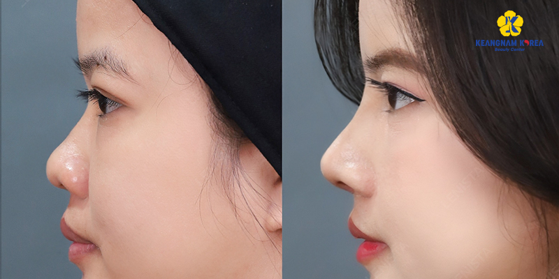 8 cách làm mũi cao tự nhiên mà vẫn an toàn theo chuẩn công nghệ mới nhất hiện nay 6 8 cách làm mũi cao tự nhiên