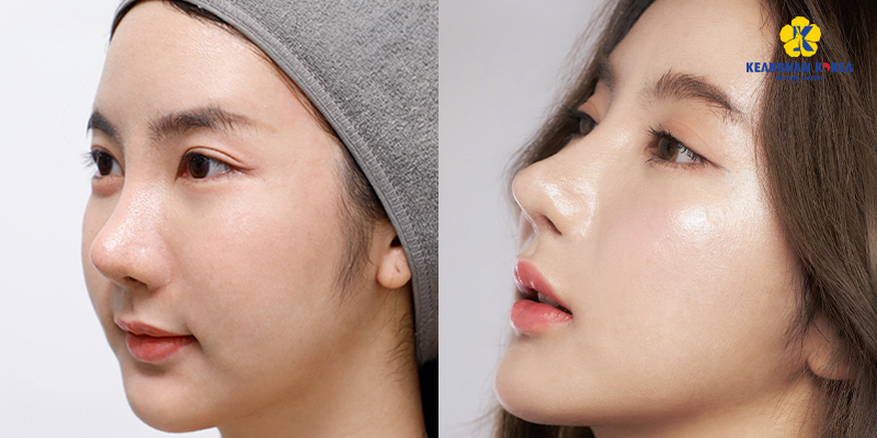 Nâng mũi gồm những phương pháp nào? Giá bao nhiêu? Bao lâu thì đẹp? Có nguy hiểm không? Các kinh nghiệm và rủi ro thường gặp 4 Hình ảnh thực tế khi nâng mũi S-line