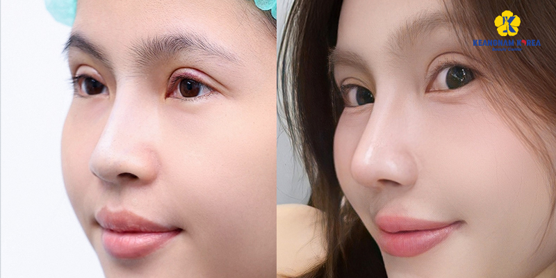 Nâng mũi sụn tự thân giá bao nhiêu? Bảng giá mới nhất 2026 2 Nâng mũi sụn tự thân giá bao nhiêu