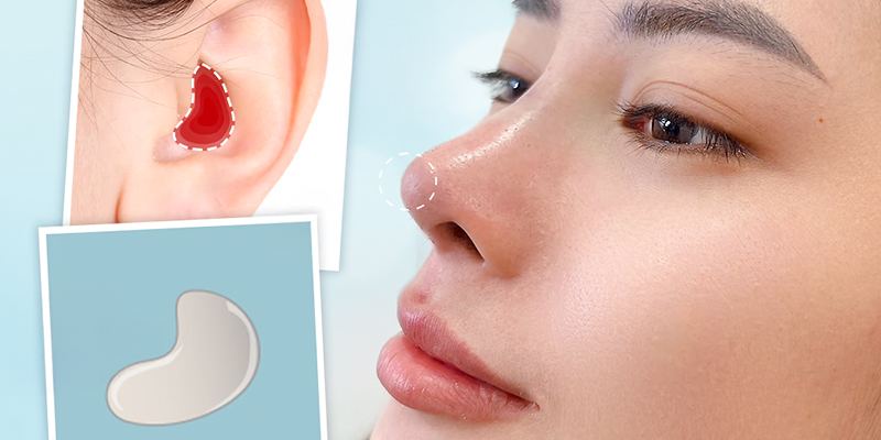 Nâng mũi sụn tự thân giá bao nhiêu? Bảng giá mới nhất 2026 3 Nâng mũi sụn tai giá bao nhiêu