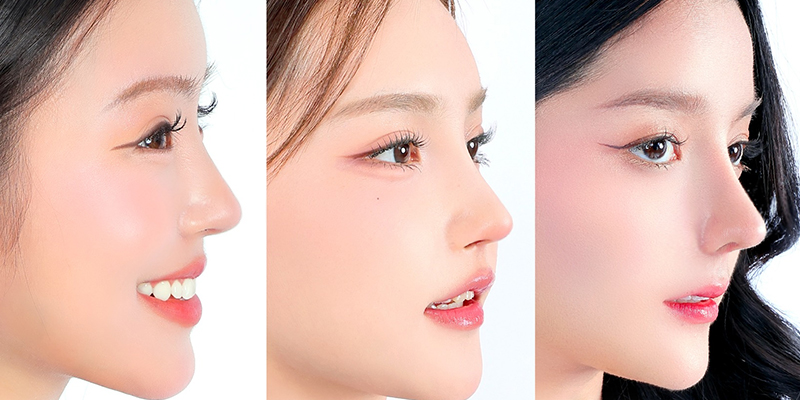 Nâng mũi sụn tự thân giá bao nhiêu? Bảng giá mới nhất 2026 1 Nâng mũi sụn tự thân giá bao nhiêu