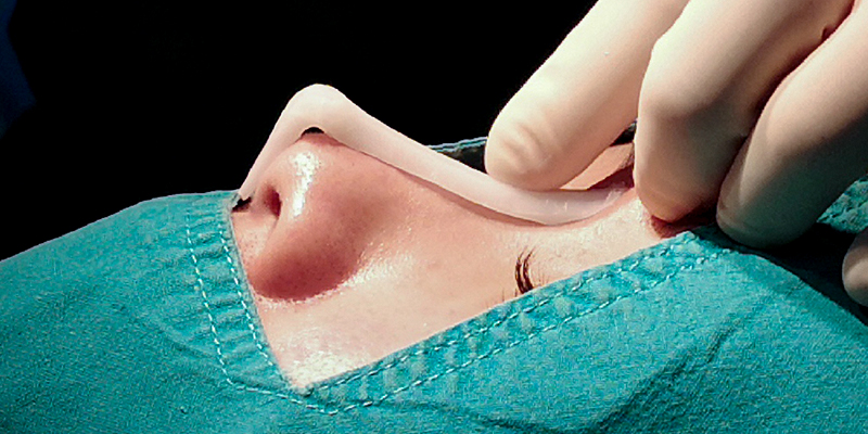 Sống mũi cao, thẳng có ý nghĩa gì trong thẩm mỹ? Đâu là các phương pháp nâng mũi phù hợp để có sống mũi cao? 4 Sống mũi cao, thẳng có ý nghĩa gì trong thẩm mỹ khuôn mặt?