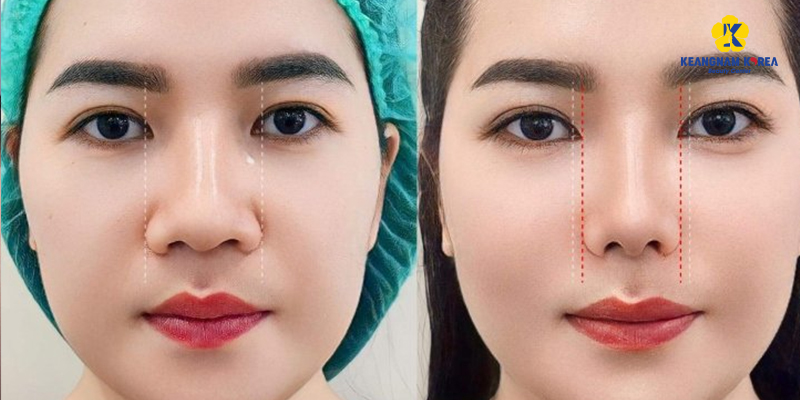 Tổng hợp bài tập và cách làm mũi nhỏ lại mà không cần phẫu thuật 5 bài tập cho mũi nhỏ lại