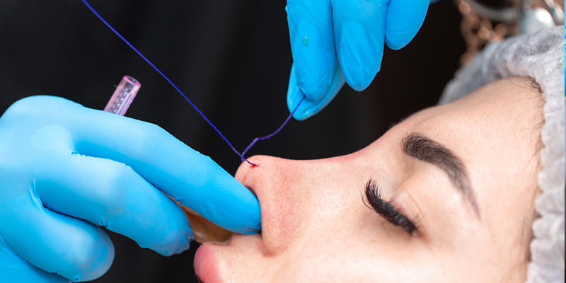 Các phương pháp nâng mũi không phẫu thuật tốt nhất 2026 3 Nâng mũi bằng chỉ sinh học