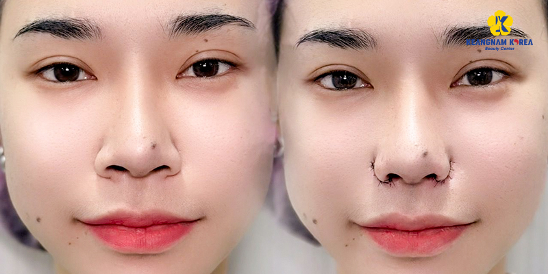 9 cách giúp cánh mũi nhỏ lại và thon gọn hơn 5 9 cách giúp cánh mũi nhỏ lại