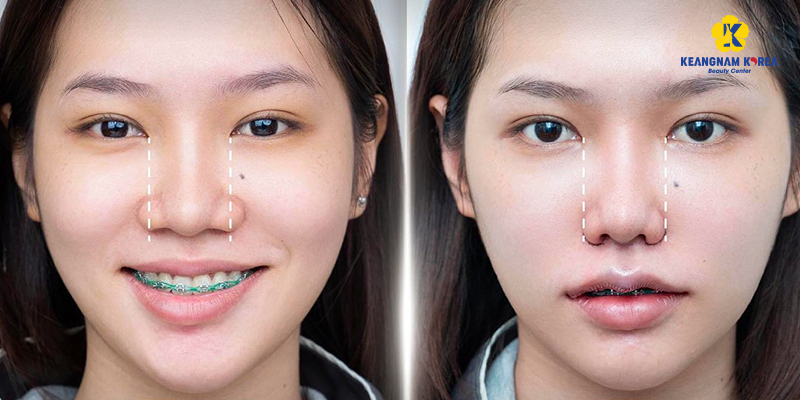 Đâu là cách giúp đầu mũi nhỏ lại và thanh tú hơn? 4 cách giúp đầu mũi nhỏ lại