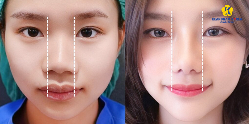 Cách Làm Lỗ Mũi Nhỏ Lại Nhanh Chóng, An Toàn Và Hiệu Quả Tại Nhà 4 Cách Làm Lỗ Mũi Nhỏ Lại Nhanh Chóng, An Toàn Và Hiệu Quả Tại Nhà