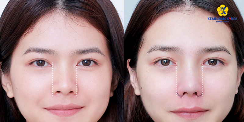 Cách Làm Lỗ Mũi Nhỏ Lại Nhanh Chóng, An Toàn Và Hiệu Quả Tại Nhà 1 Cách Làm Lỗ Mũi Nhỏ Lại Nhanh Chóng, An Toàn Và Hiệu Quả Tại Nhà